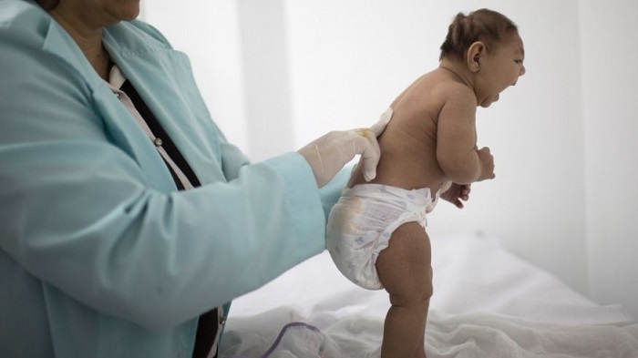 Zika birth defect may only become clear months after birth 